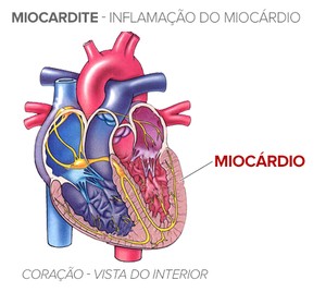O que a Miocardite?